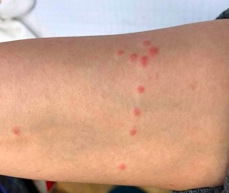 укусы постельных клопов укусы клопов